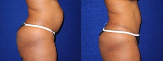 Right Profile View - Tummy Tuck After Pregnancy