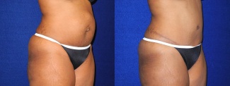 Right 3/4 View - Tummy Tuck After Pregnancy