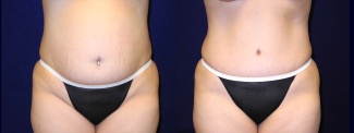 Frontal View - Tummy Tuck After Pregnancy