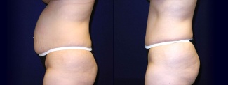 Left Profile View - Tummy Tuck After Pregnancy