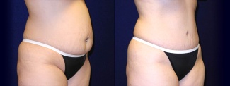 Right 3/4 View - Tummy Tuck After Pregnancy