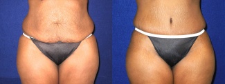 Frontal View - Tummy Tuck After Pregnancy