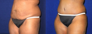 Left 3/4 View -Tummy Tuck After Pregnancy