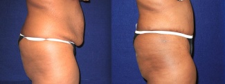 Right Profile View - Tummy Tuck After Pregnancy