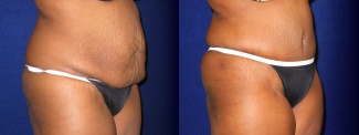 Right 3/4 View - Tummy Tuck After Pregnancy