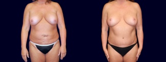 Frontal View - Breast Implant Revision with Lift & Tummy Tuck