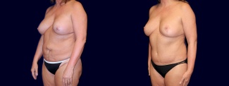 Left 3/4 View - Breast Implant Revision with Lift & Tummy Tuck