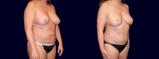 Right 3/4 View - Breast Implant Revision with Lift & Tummy Tuck
