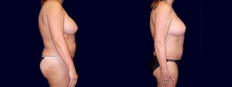 Right Profile View - Breast Implant Revision with Lift & Tummy Tuck