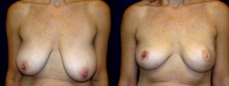 Frontal View - Breast Reconstruction