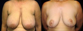 Frontal View -  Breast Reduction
