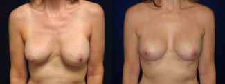 Frontal View - Breast Implant Revision - Silicone Implants