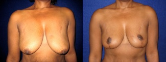 Frontal View - Breast Lift