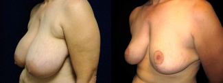 Left 3/4 View - Breast Reduction