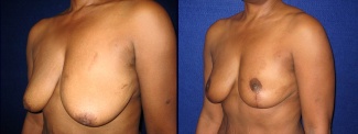 Left 3/4 View - Breast Lift