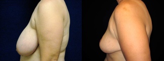 Left Profile View - Breast Reduction