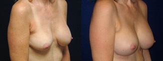 Right 3/4 View - Breast Implant Revision - Silicone Implants