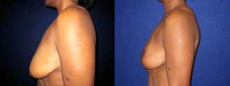 Left Profile View - Breast Lift