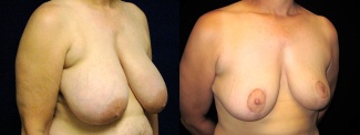 Right 3/4 View - Breast Reduction