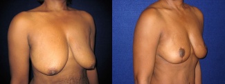 Right 3/4 View - Breast Lift