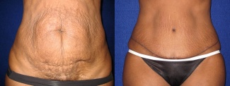 Frontal View - Tummy Tuck After Pregnancy