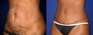 Left 3/4 View - Tummy Tuck After Pregnancy