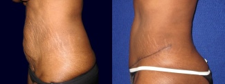 Left Profile View - Tummy Tuck After Pregnancy