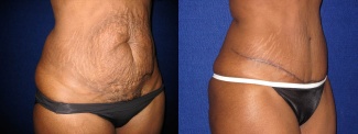 Right 3/4 View - Tummy Tuck After Pregnancy