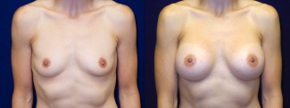 Frontal View - Breast Augmentation - Silicone Implants