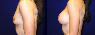 Left Profile View - Breast Augmentation - Silicone Implants