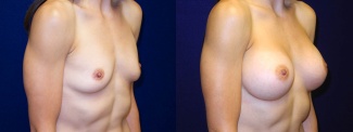 Right 3/4 View - Breast Augmentation - Silicone Implants