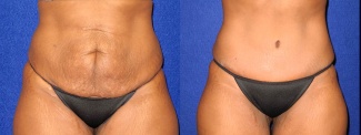 Frontal View - Tummy Tuck After Pregnancy