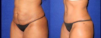 Left 3/4 View - Tummy Tuck After Pregnancy