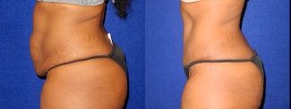 Left Profile View - Tummy Tuck After Pregnancy