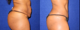 Right Profile View - Tummy Tuck After Pregnancy