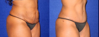 Right 3/4 View - Tummy Tuck After Pregnancy