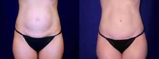 Frontal View - Tummy Tuck After Pregnancy