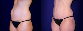 Left 3/4 View -Tummy Tuck After Pregnancy