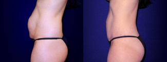 Left Profile View -Tummy Tuck After Pregnancy