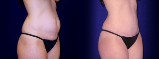 Right 3/4 View - Tummy Tuck After Pregnancy