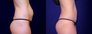 Right Profile View - Tummy Tuck After Pregnancy