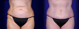 Frontal View - Tummy Tuck After Pregnancy