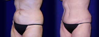 Left 3/4 View - Tummy Tuck After Pregnancy