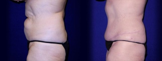 Left Profile View - Tummy Tuck After Pregnancy