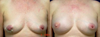 Frontal View - Breast Reconstruction