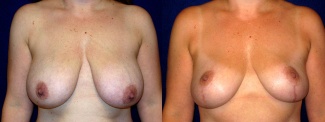 Frontal View - Breast Reduction