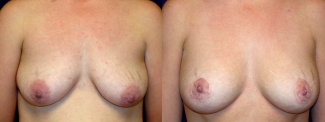 Frontal View - Breast Augmentation with Periareolar Lift - Saline Implants