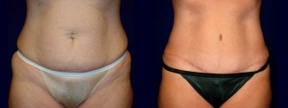 Frontal View - Tummy Tuck After Pregnancy