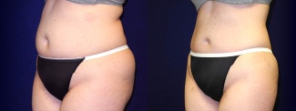 Left 3/4 View -Liposuction