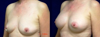 Left 3/4 View - Breast Reconstruction